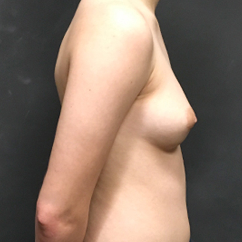 Female To Male Top Surgery 09