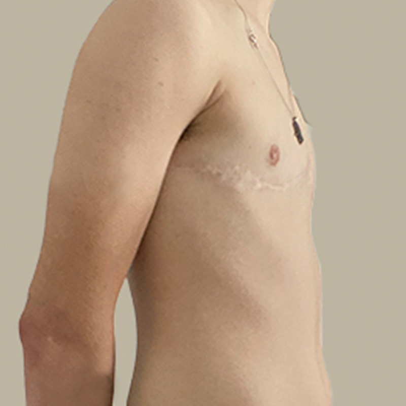 Female To Male Top Surgery 09