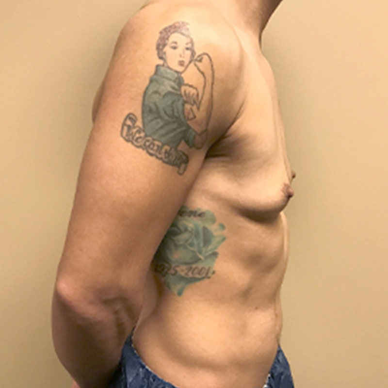 Female To Male Top Surgery 09