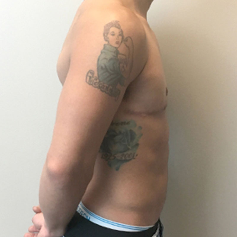 Female To Male Top Surgery 09