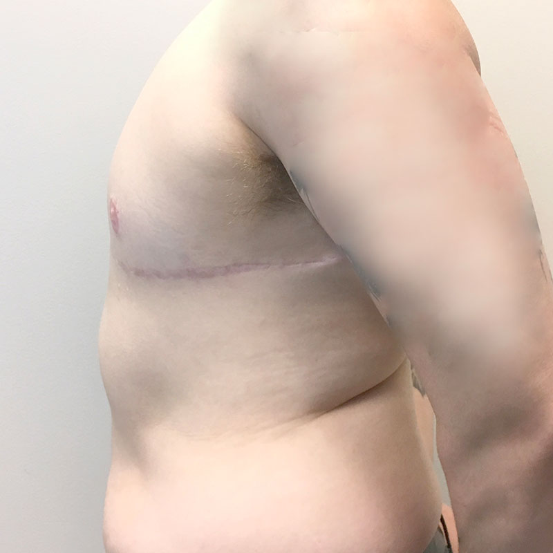 Female To Male Top Surgery 05