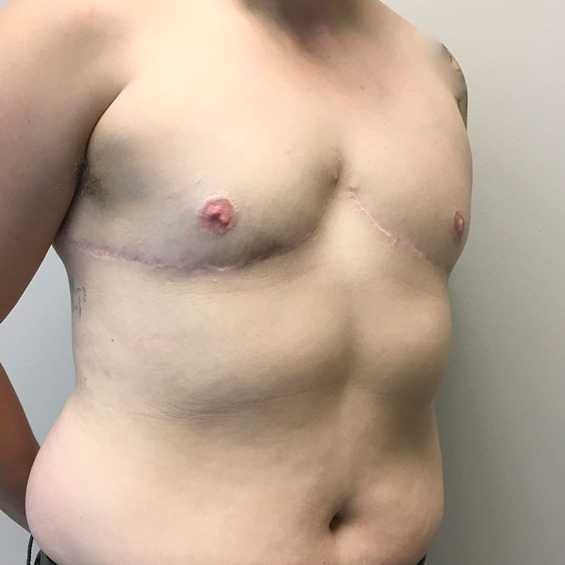 Female To Male Top Surgery 07