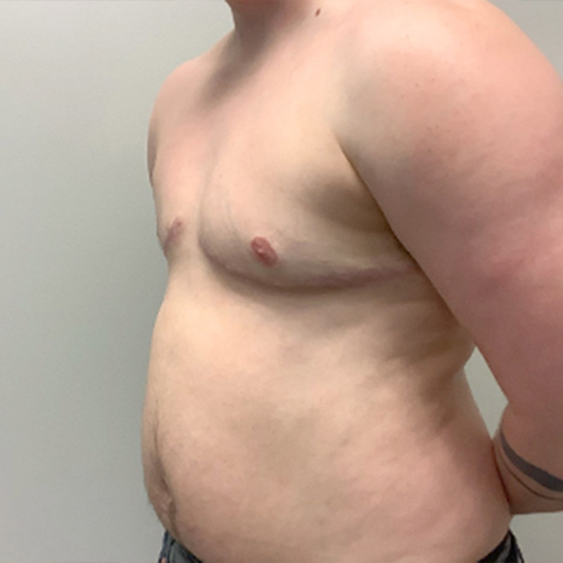 Female To Male Top Surgery 03