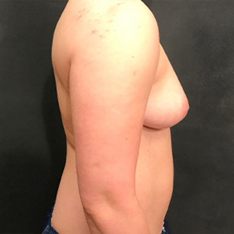 Female To Male Top Surgery 09