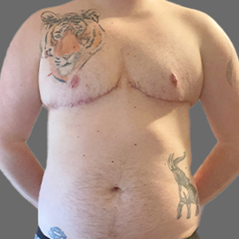 Female To Male Top Surgery 101