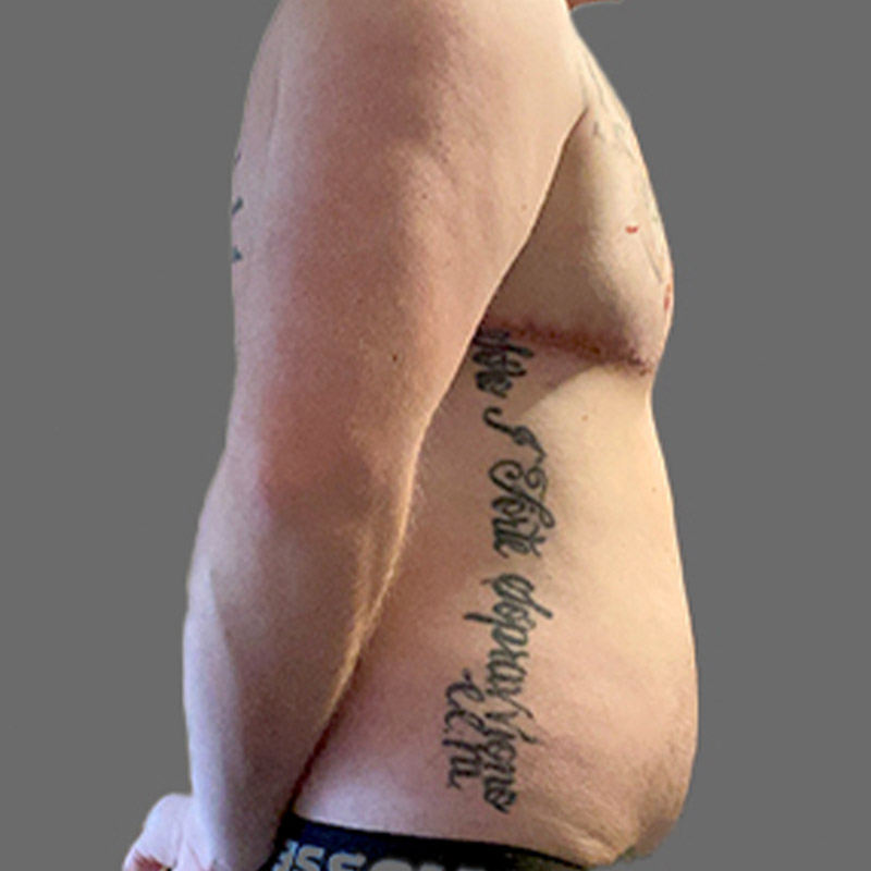 Female To Male Top Surgery 09