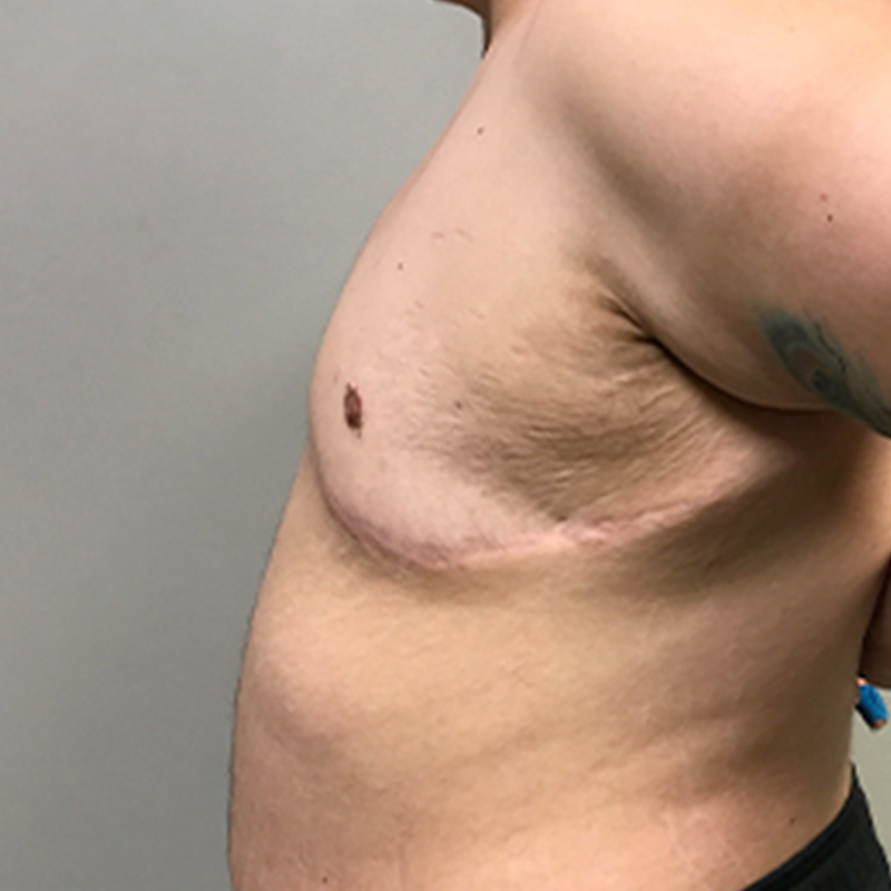 Female To Male Top Surgery 03