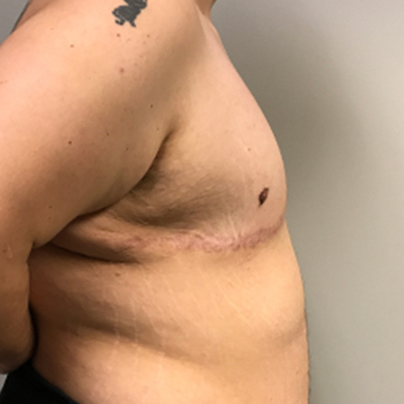 Female To Male Top Surgery 05