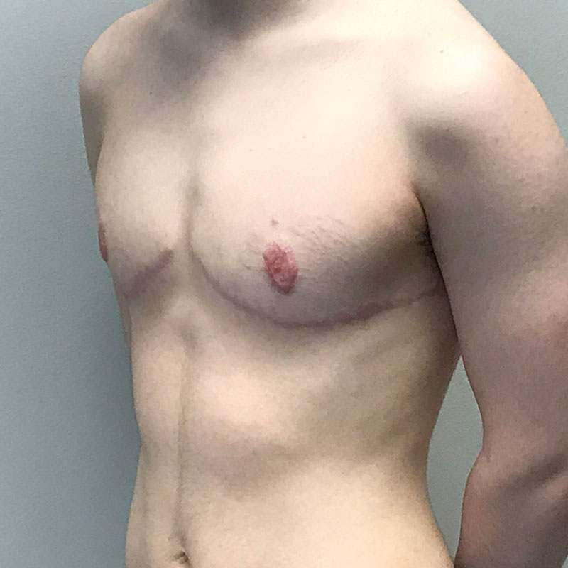 Female To Male Top Surgery 03