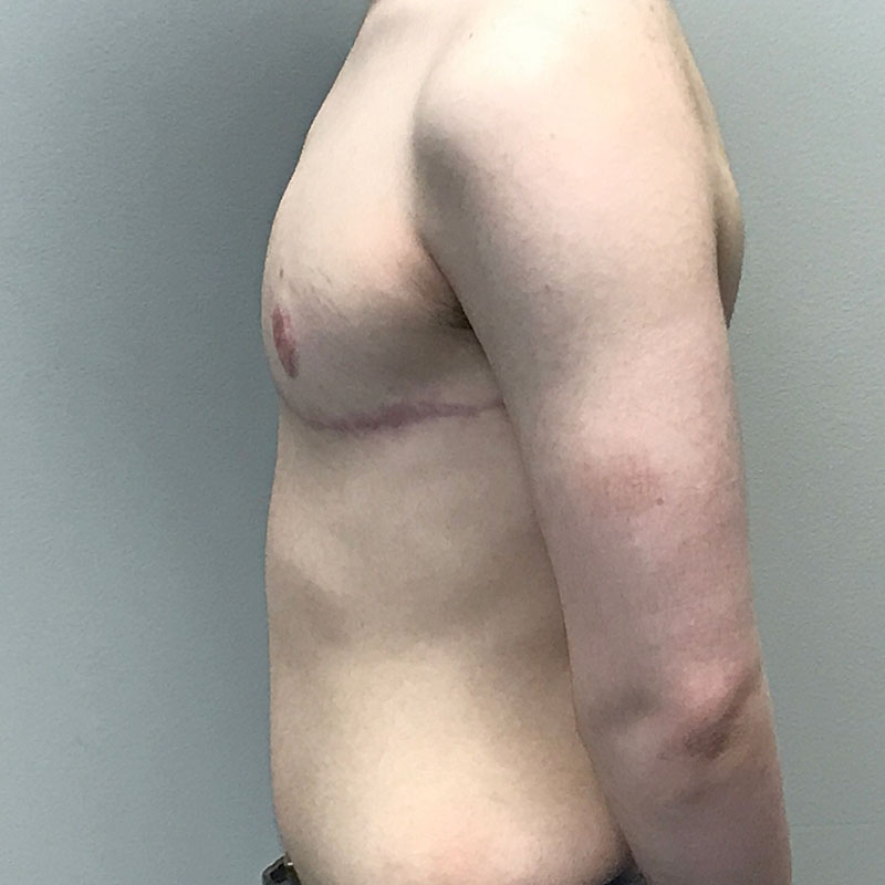 Female To Male Top Surgery 05