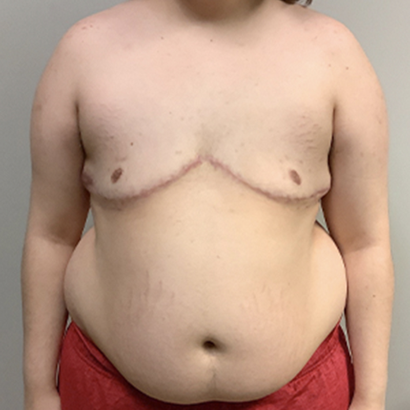 Female To Male Top Surgery 104