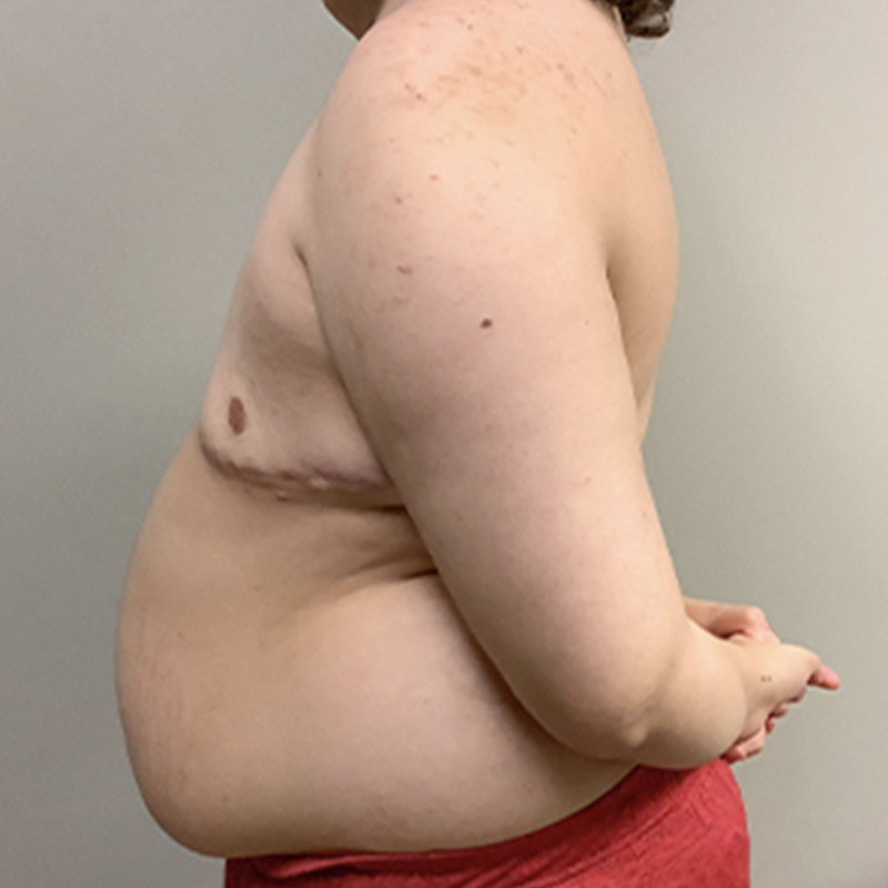 Female To Male Top Surgery 05