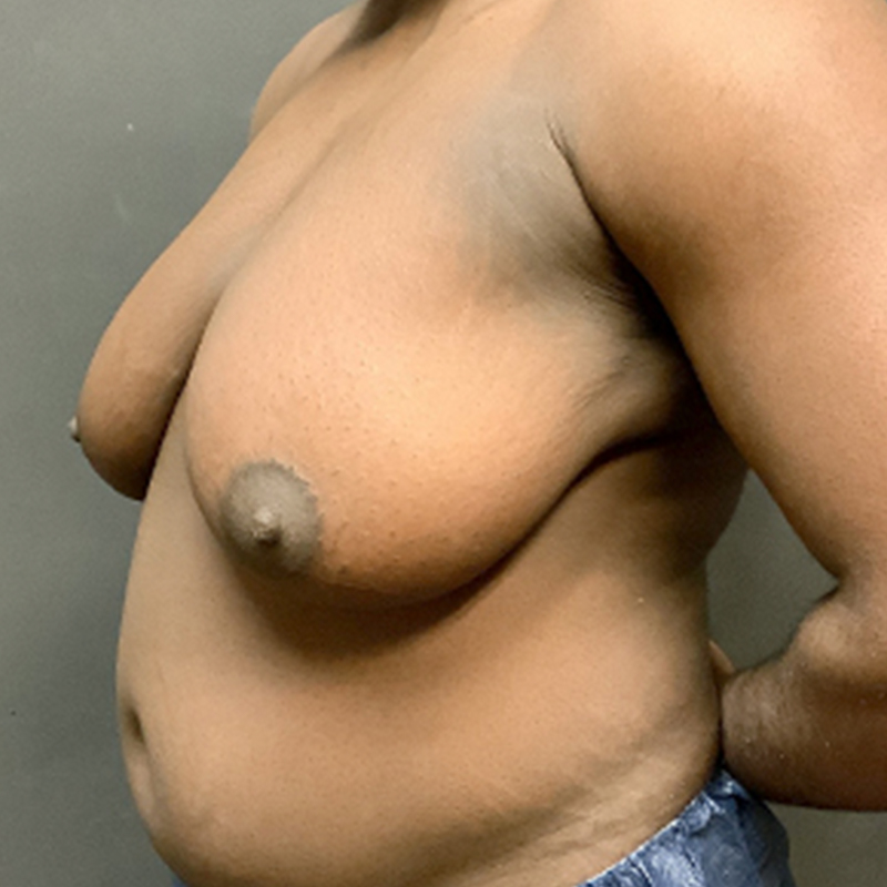 Female To Male Top Surgery 03