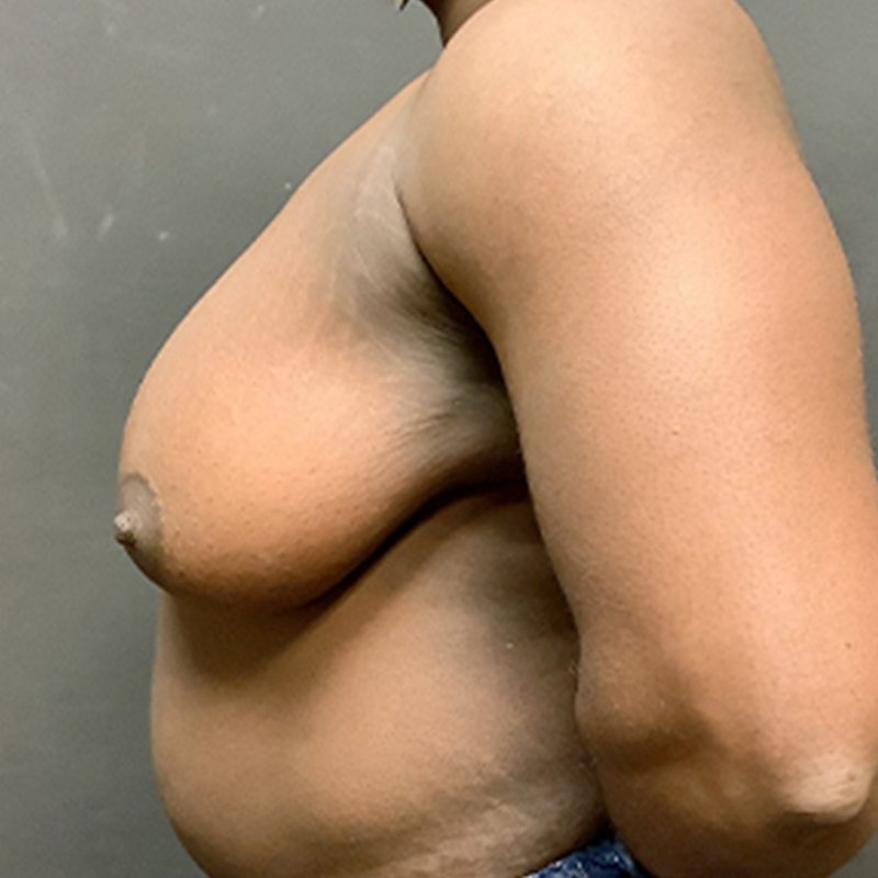 Female To Male Top Surgery 05