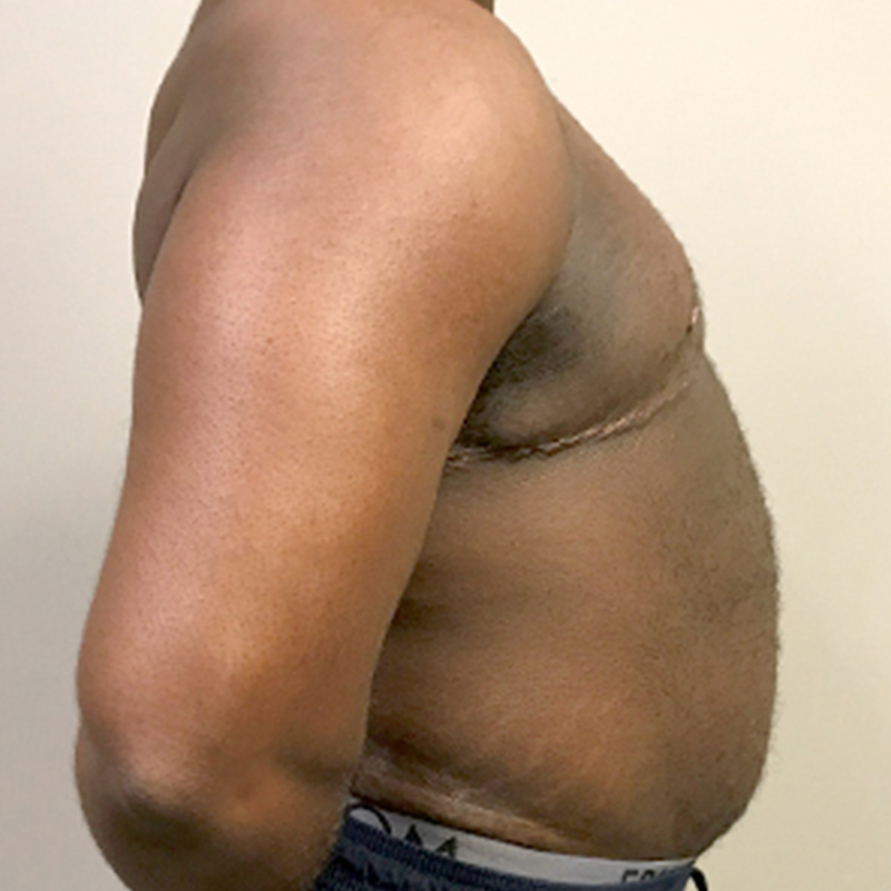 Female To Male Top Surgery 09