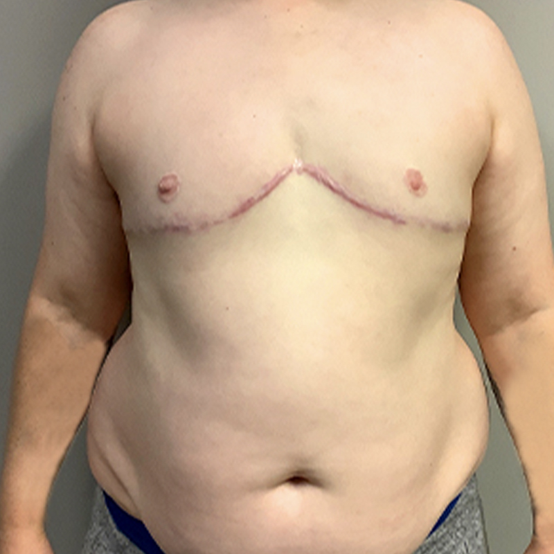 Female To Male Top Surgery 106