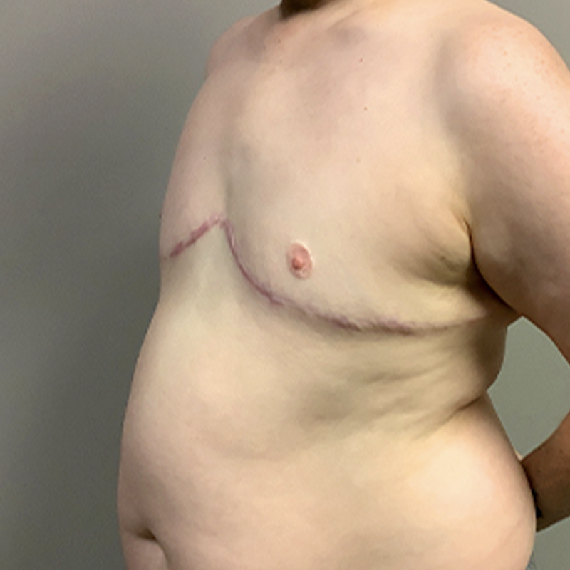 Female To Male Top Surgery 03