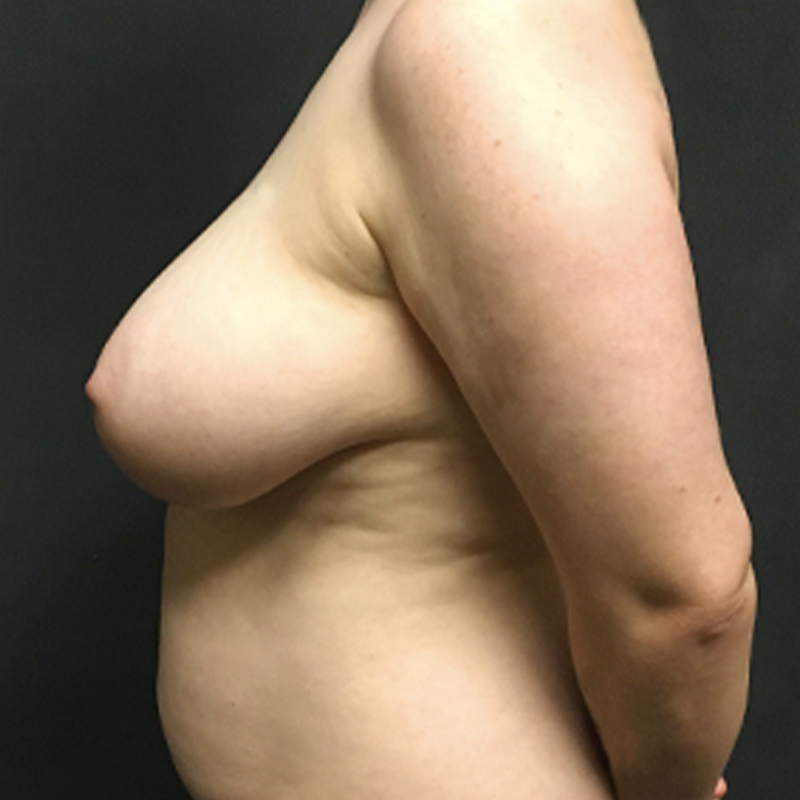 Female To Male Top Surgery 05