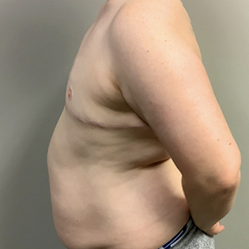 Female To Male Top Surgery 05