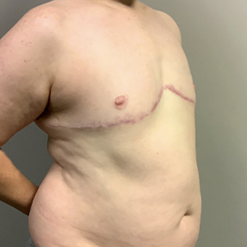 Female To Male Top Surgery 07