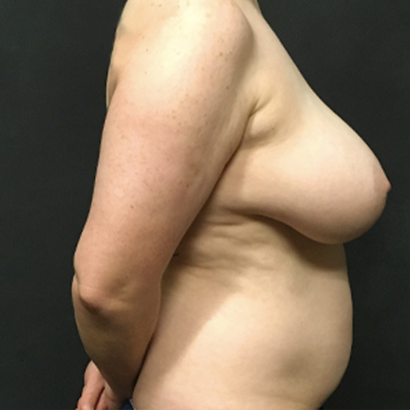 Female To Male Top Surgery 09