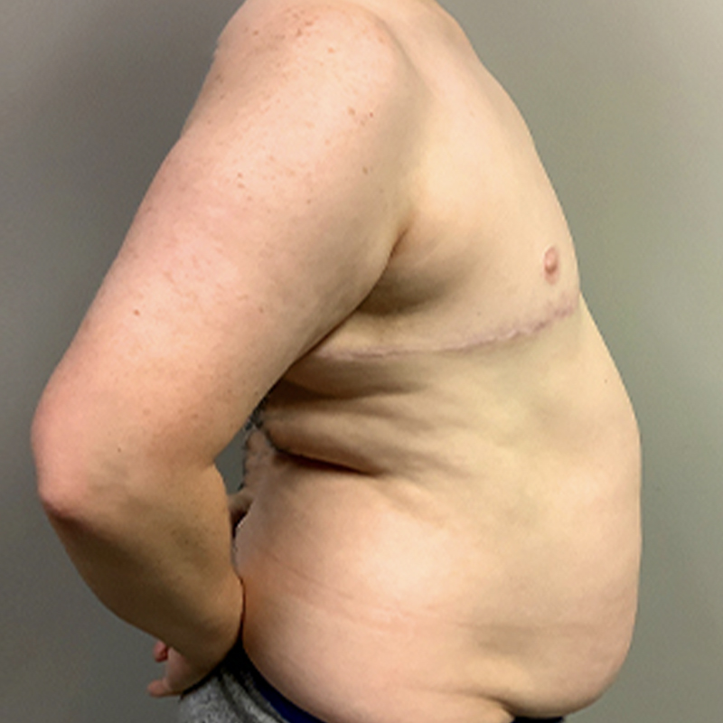 Female To Male Top Surgery 09