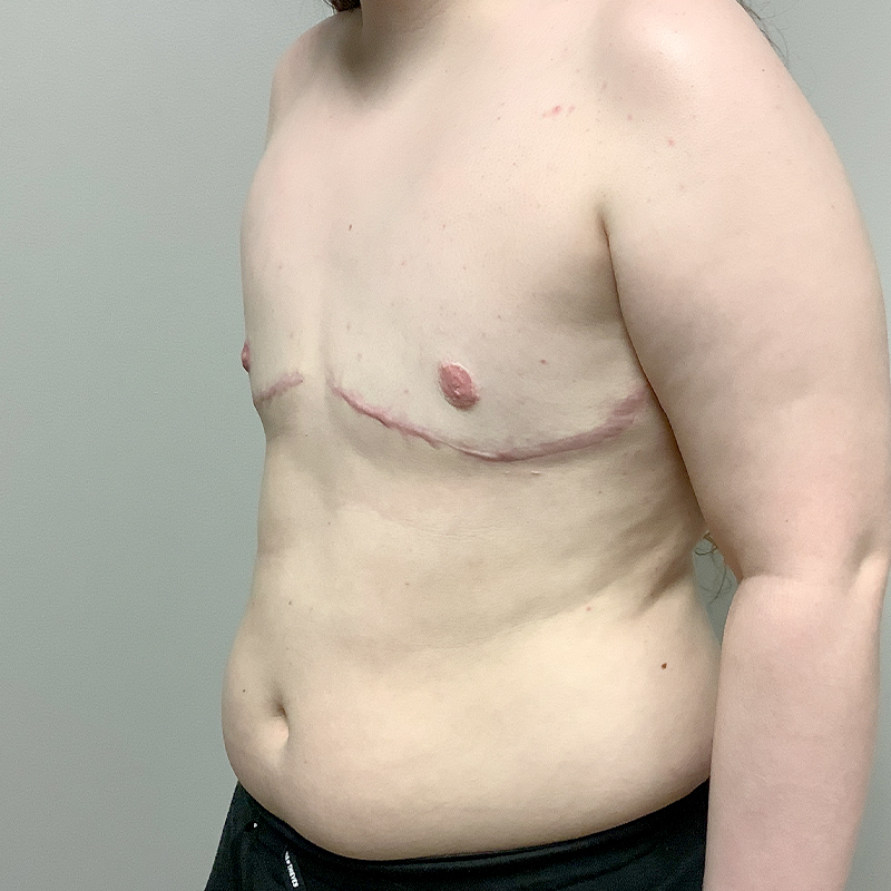 Female To Male Top Surgery 03