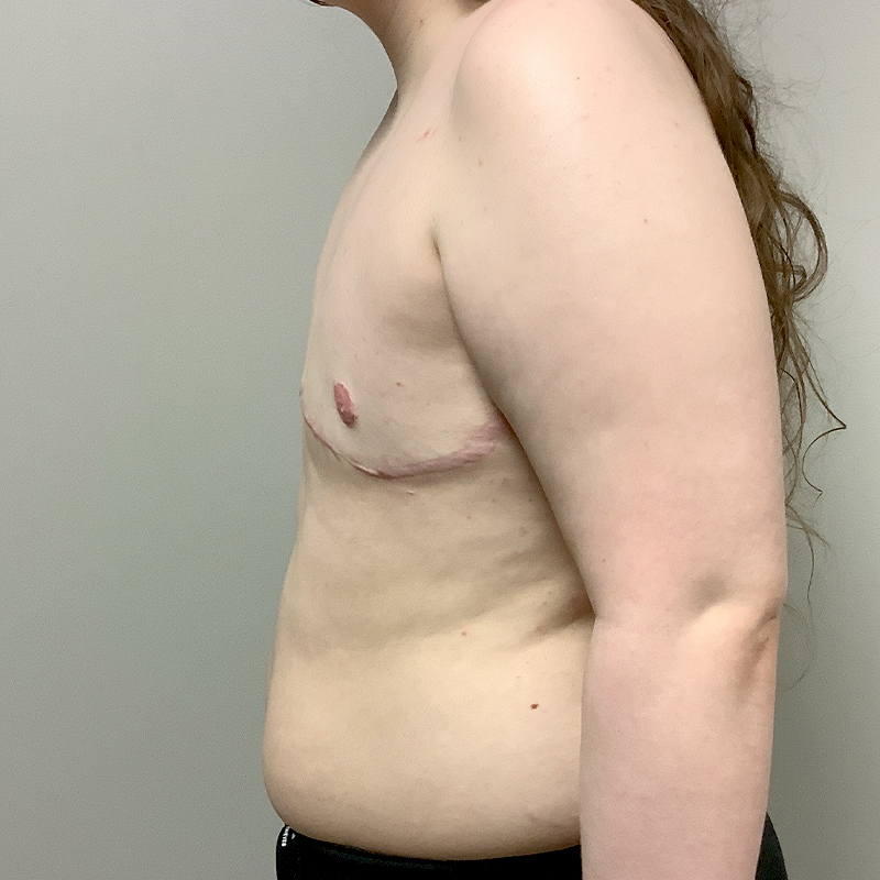 Female To Male Top Surgery 07