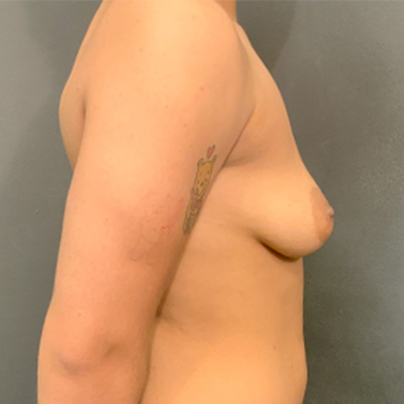 Female To Male Top Surgery 05