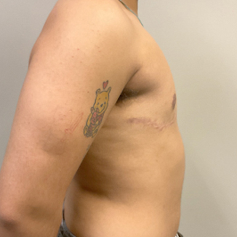 Female To Male Top Surgery 05