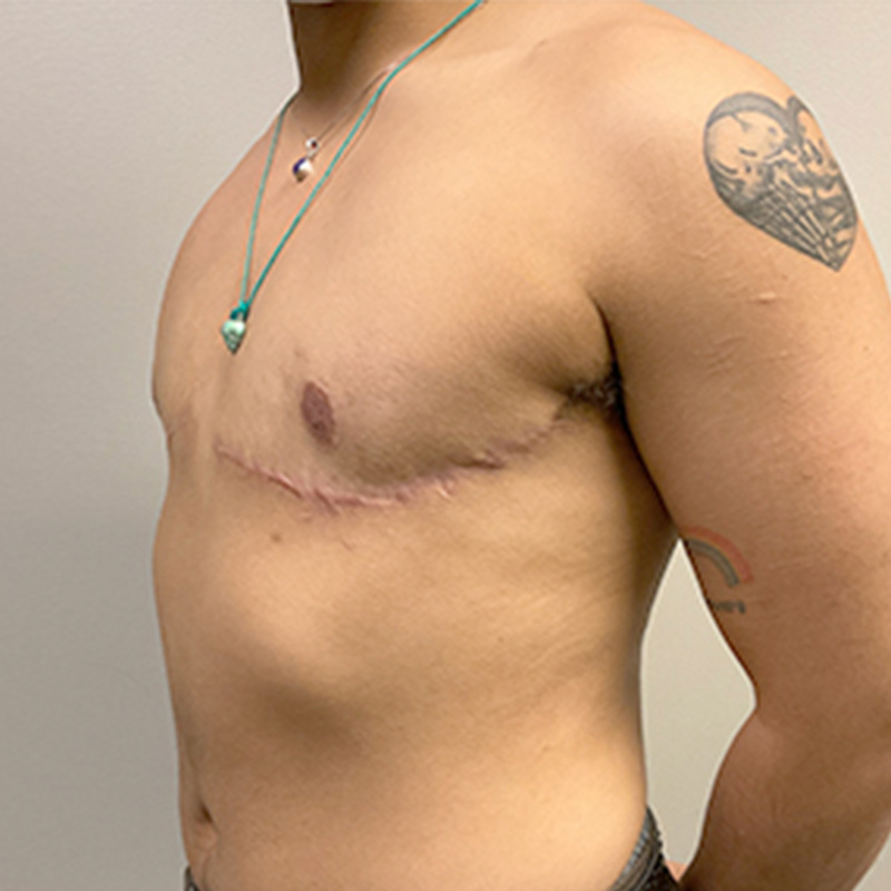 Female To Male Top Surgery 07