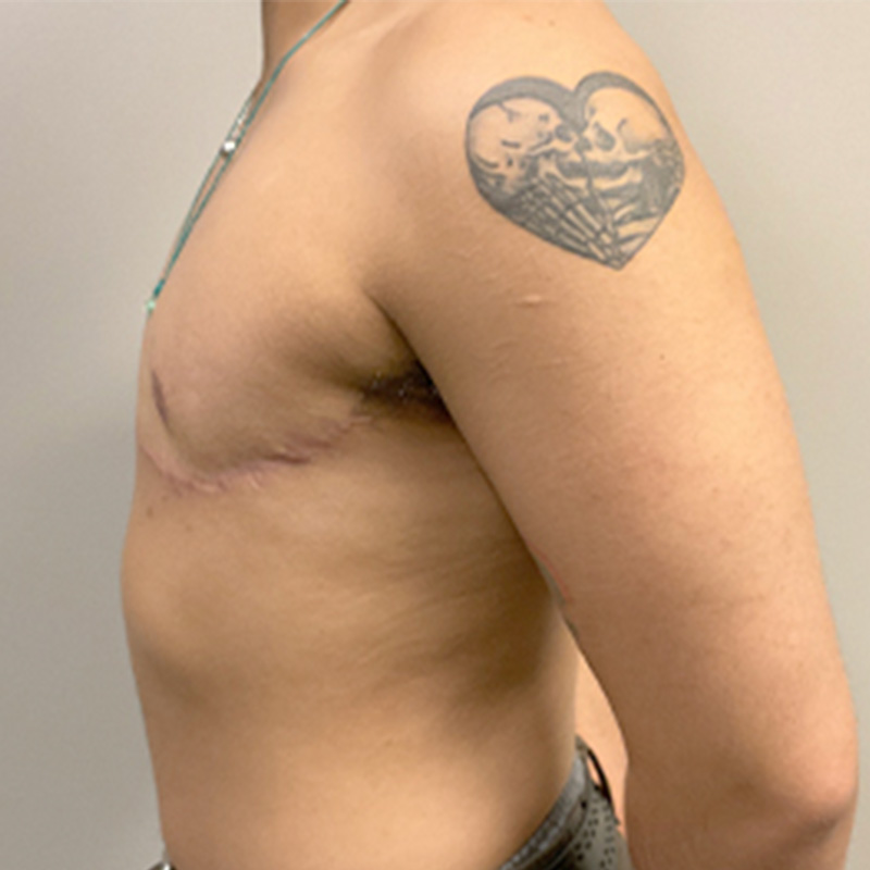 Female To Male Top Surgery 09