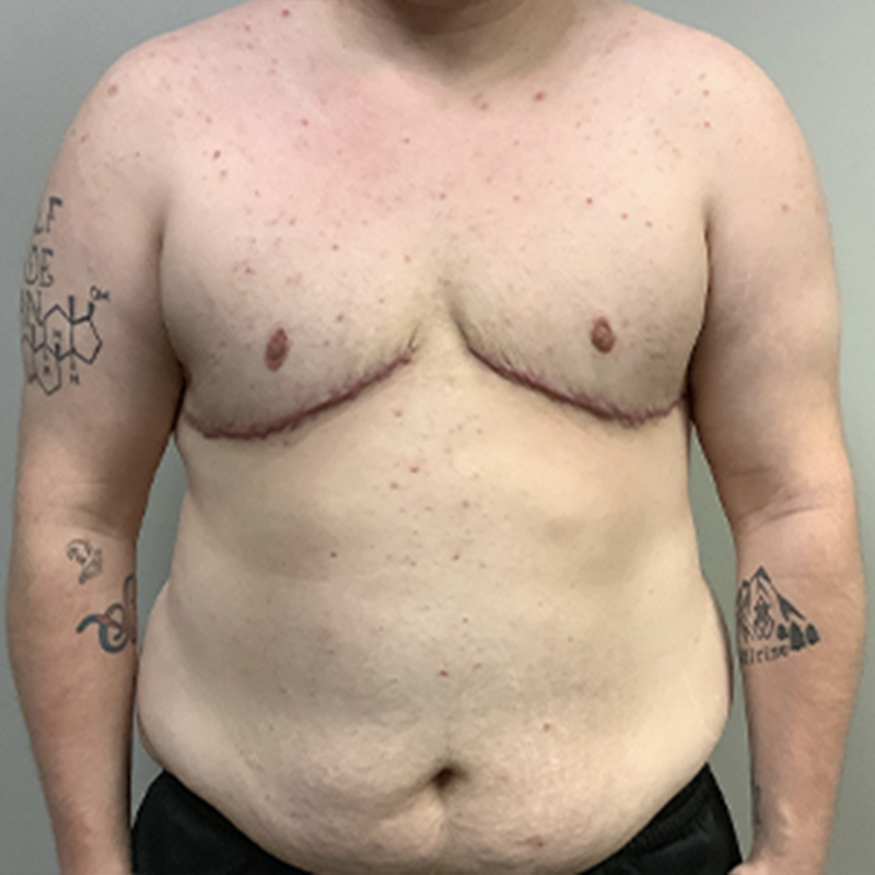 Female To Male Top Surgery 109