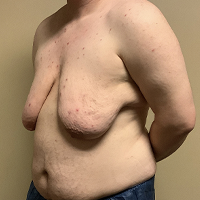 Female To Male Top Surgery 03