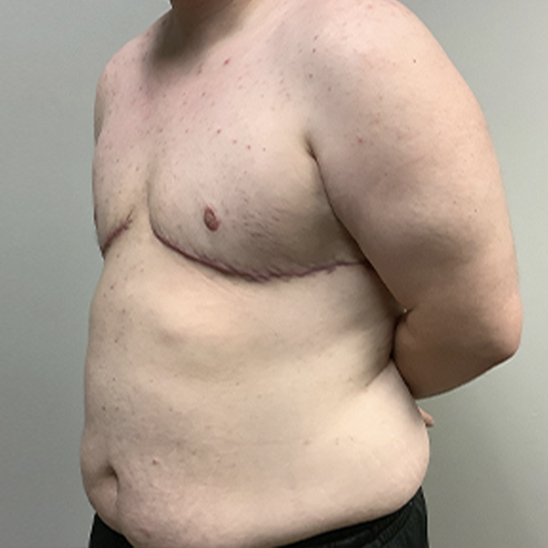 Female To Male Top Surgery 03