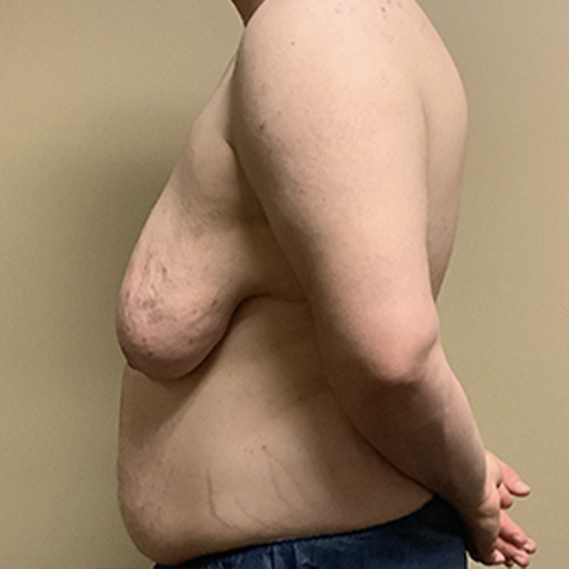 Female To Male Top Surgery 05