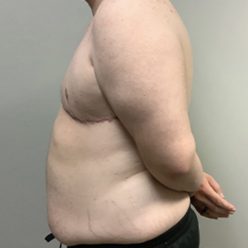 Female To Male Top Surgery 05