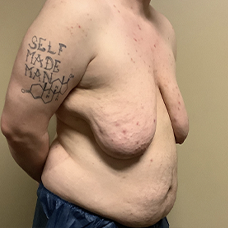 Female To Male Top Surgery 07