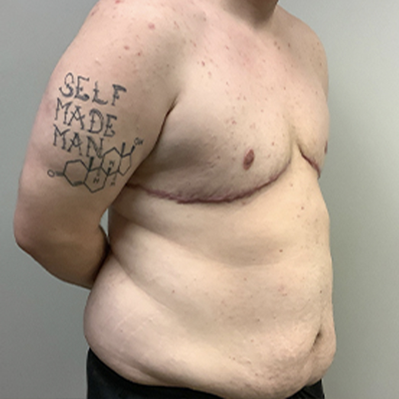 Female To Male Top Surgery 07