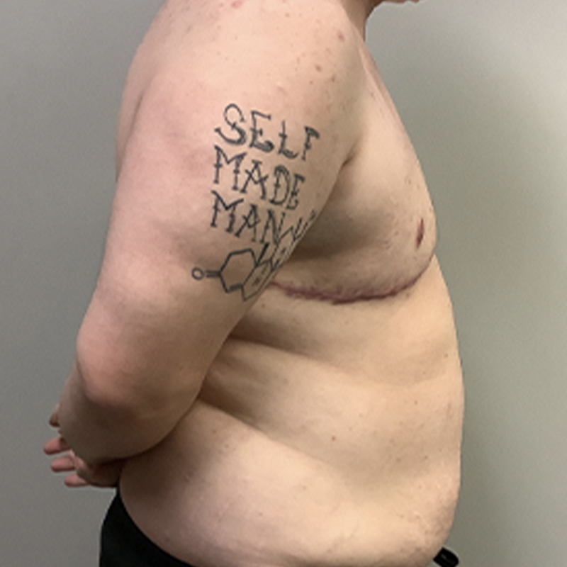 Female To Male Top Surgery 09