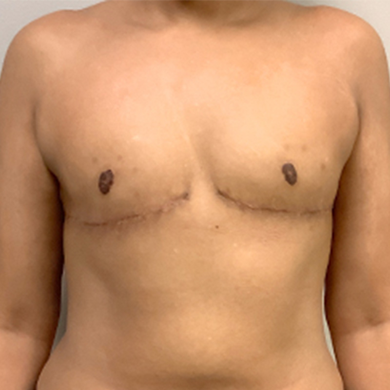 Female To Male Top Surgery 11