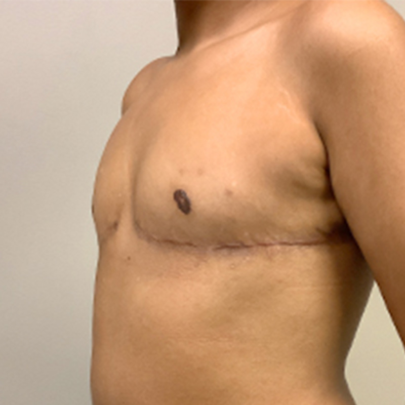 Female To Male Top Surgery 03