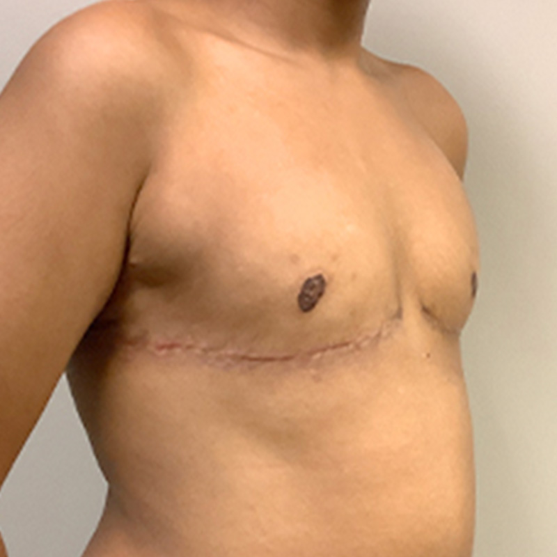 Female To Male Top Surgery 07