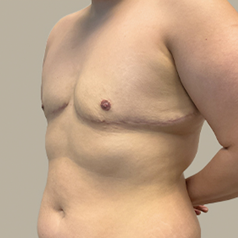 Female To Male Top Surgery 110