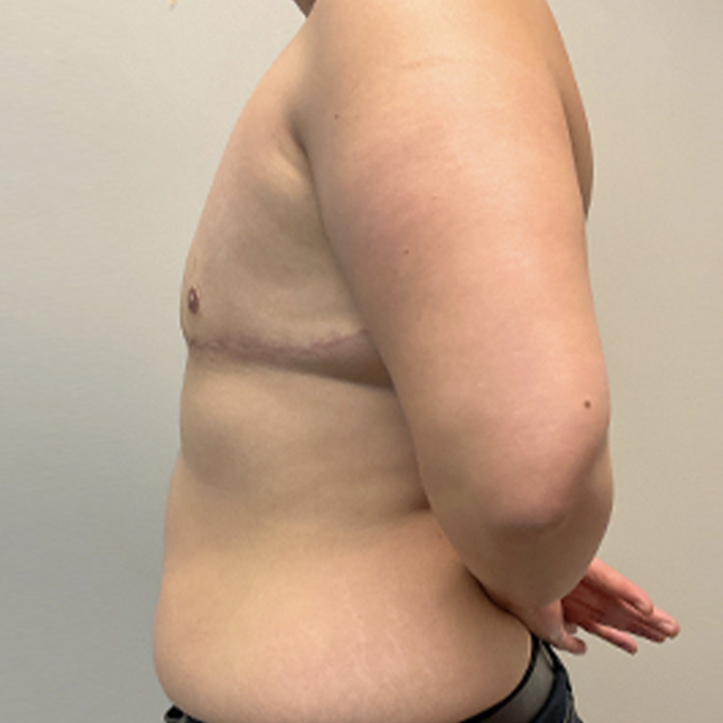 Female To Male Top Surgery 03