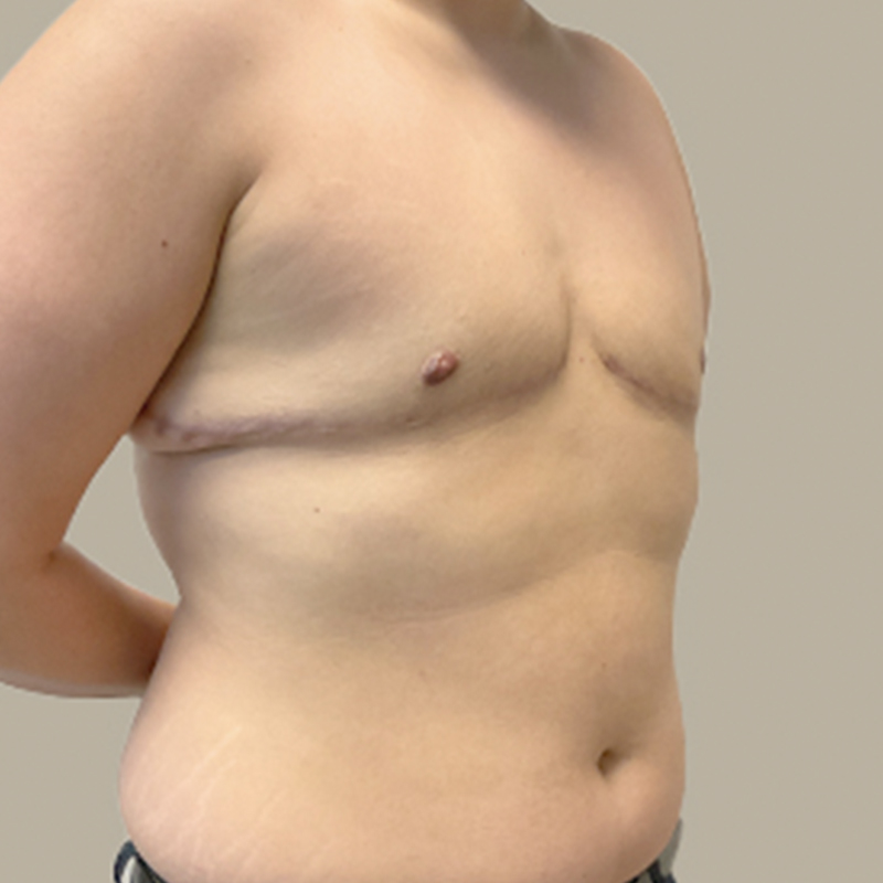 Female To Male Top Surgery 05