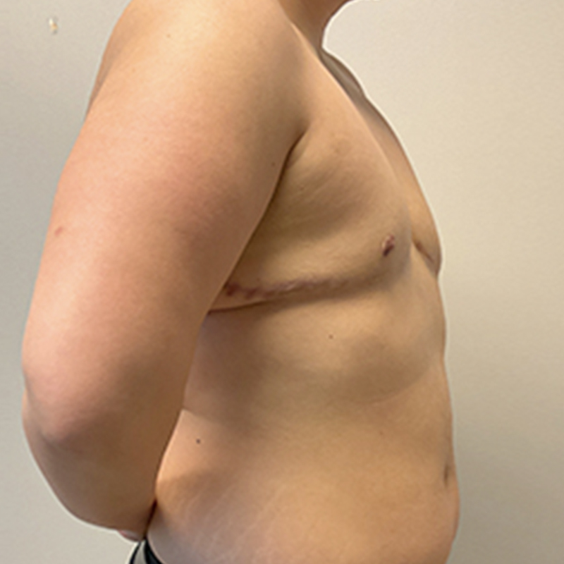 Female To Male Top Surgery 07