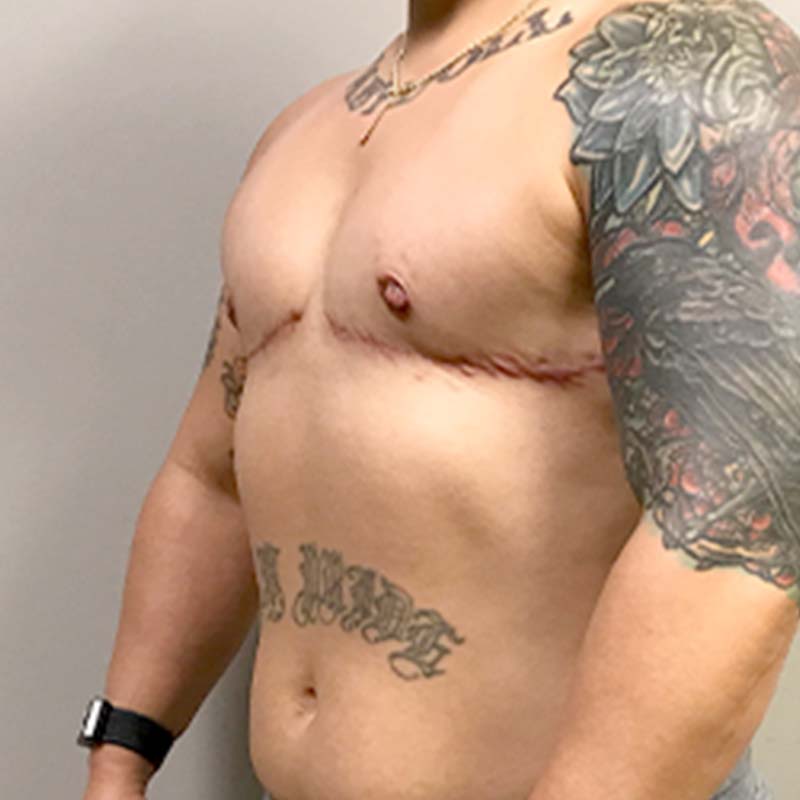 Female To Male Top Surgery 03