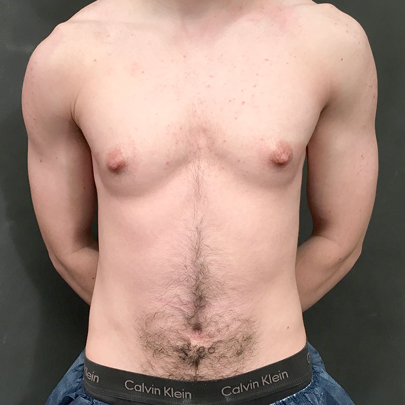 Female To Male Top Surgery 01