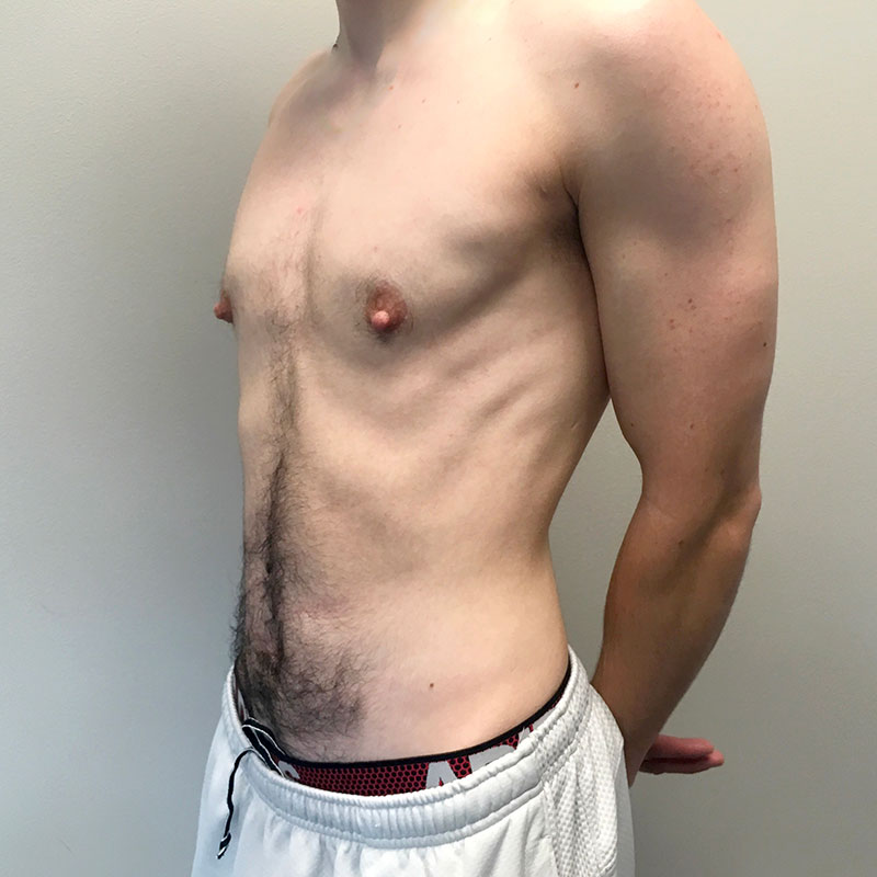 Female To Male Top Surgery 03